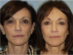 Blepharoplasty (Eyelid Surgery)