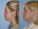 Rhinoplasty (Nose Job)