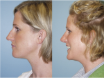 Rhinoplasty (Nose Job)