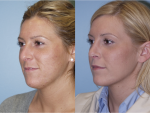 Rhinoplasty (Nose Job)