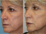 Lip Augmentation & Injection