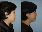 Chin and Submental Liposuction