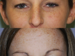 Botox and Injectables