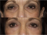 Blepharoplasty (Eyelid Surgery)