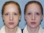 Rhinoplasty (Nose Job)