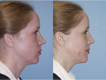 Rhinoplasty (Nose Job)