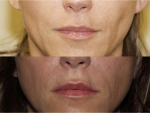 Lip Augmentation & Injection