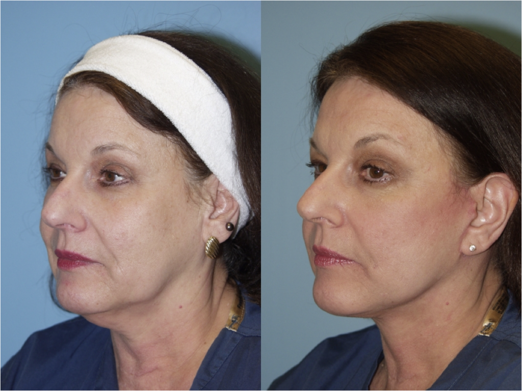 Facelift and Necklift