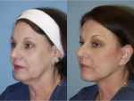 Facelift and Necklift