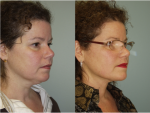 Chin and Submental Liposuction