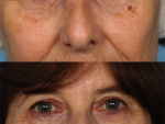 Blepharoplasty (Eyelid Surgery)