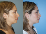 Rhinoplasty (Nose Job)