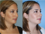 Rhinoplasty (Nose Job)