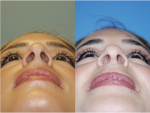 Rhinoplasty (Nose Job)