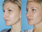 Rhinoplasty (Nose Job)