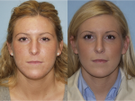 Rhinoplasty (Nose Job)