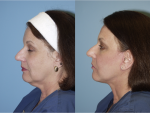 Facelift and Necklift