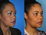 Skin Resurfacing