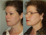 Chin and Submental Liposuction