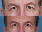 Blepharoplasty (Eyelid Surgery)