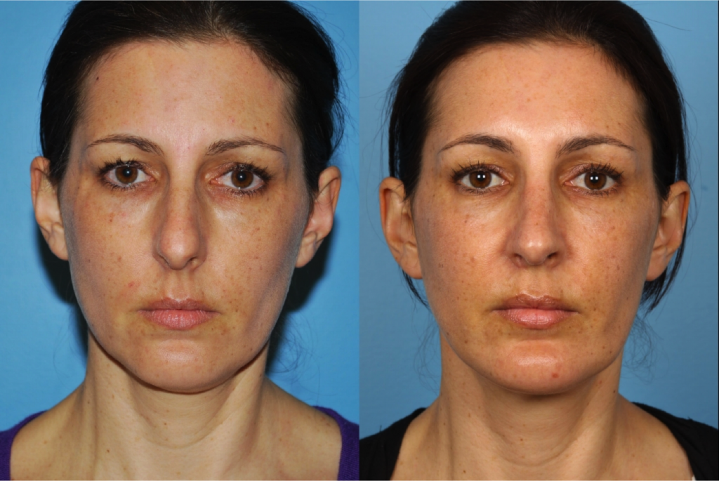 Rhinoplasty (Nose Job)