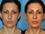 Rhinoplasty (Nose Job)