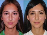 Rhinoplasty (Nose Job)