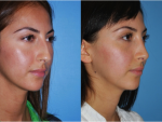 Rhinoplasty (Nose Job)