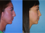 Rhinoplasty (Nose Job)