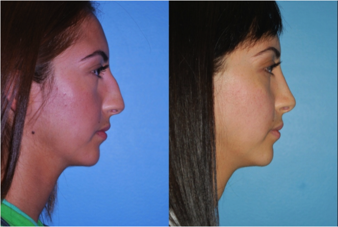 Peoria Rhinoplasty Doctors