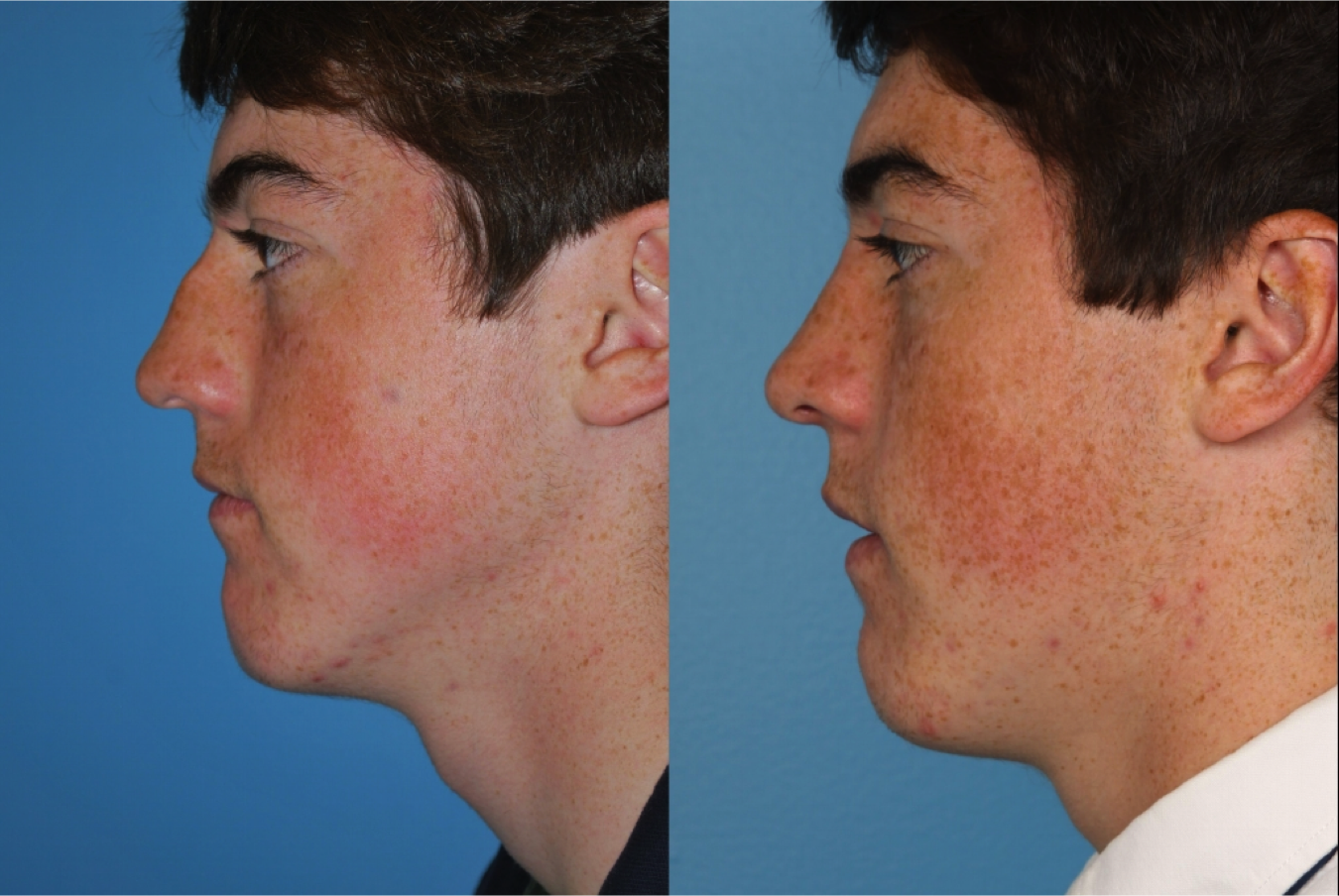 Peoria Rhinoplasty Doctors