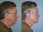 Facelift and Necklift