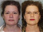 Chin and Submental Liposuction