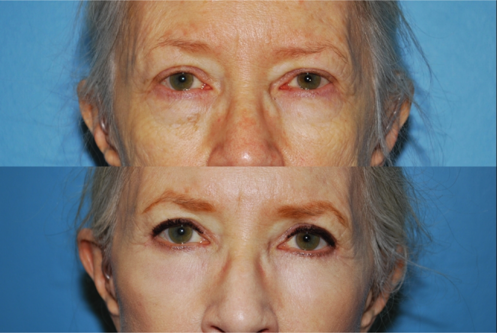 Blepharoplasty (Eyelid Surgery)
