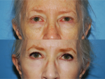 Blepharoplasty (Eyelid Surgery)