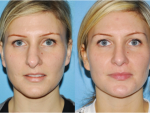 Rhinoplasty (Nose Job)