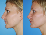 Rhinoplasty (Nose Job)