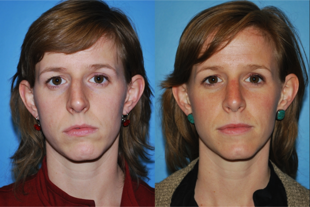 Rhinoplasty (Nose Job)