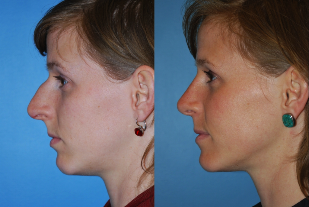 Rhinoplasty (Nose Job)