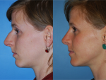 Rhinoplasty (Nose Job)