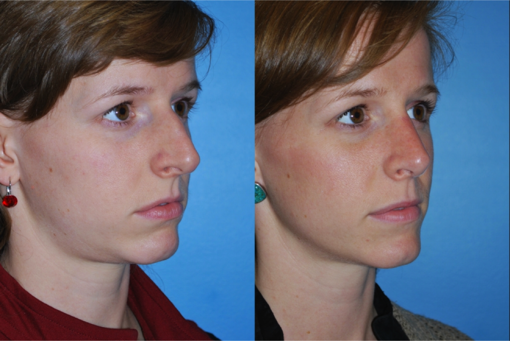 Rhinoplasty (Nose Job)