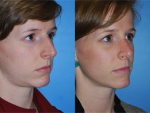 Rhinoplasty (Nose Job)