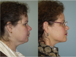 Chin and Submental Liposuction