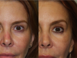 Botox and Injectables