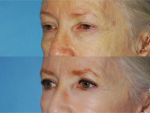 Blepharoplasty (Eyelid Surgery)