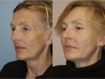 Lip Augmentation & Injection