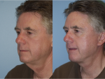 Facelift and Necklift