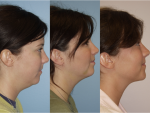 Chin and Submental Liposuction