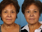 Botox and Injectables