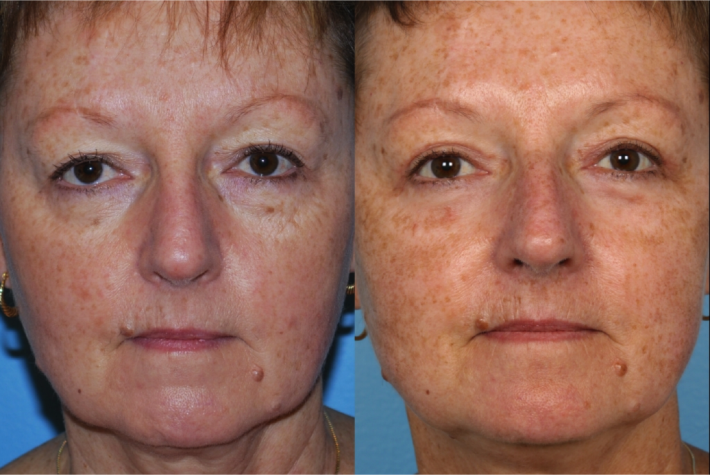 Blepharoplasty (Eyelid Surgery)